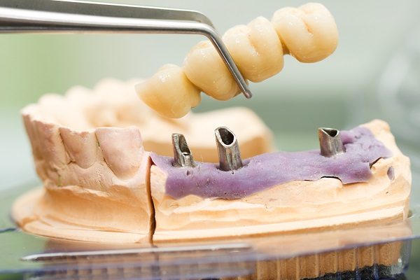 What To Expect During A Dental Bridge Procedure