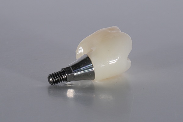 How Long Does An Implant Crown Restoration Last?