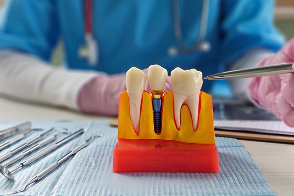 Implant Crowns: A Natural Looking Dental Restoration